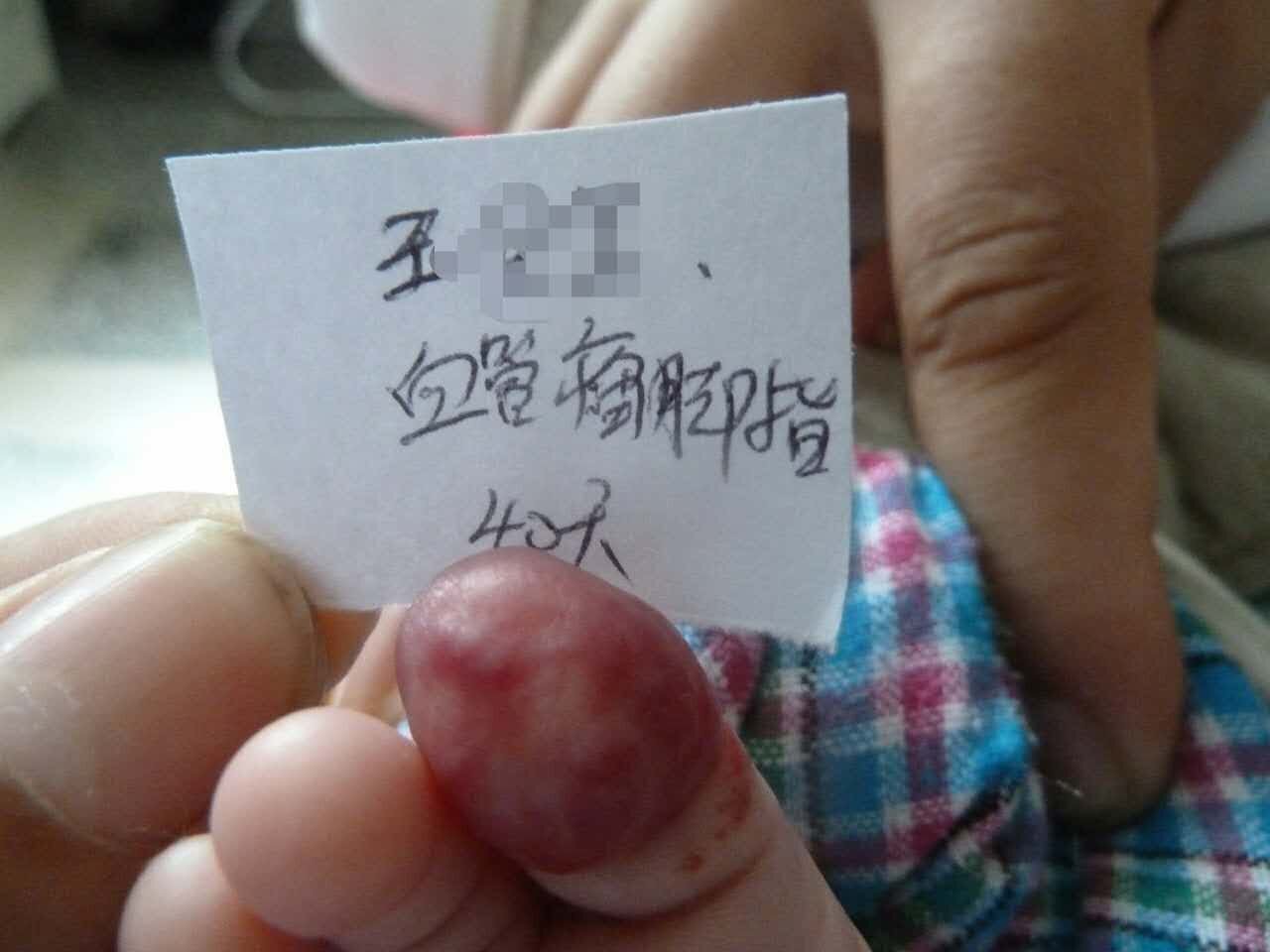 脚趾血管瘤差点截肢? - 商丘市第五人民医院